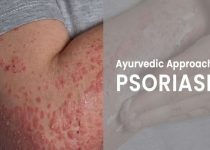 Ayurvedic Approach to PSORIASIS