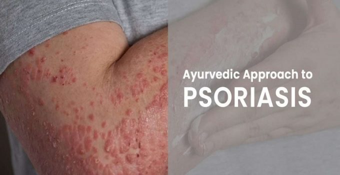 Ayurvedic Approach to PSORIASIS