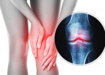 Knee Osteoarthritis