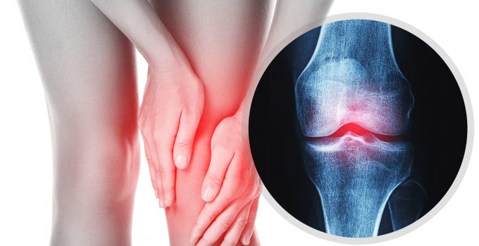 Knee Osteoarthritis